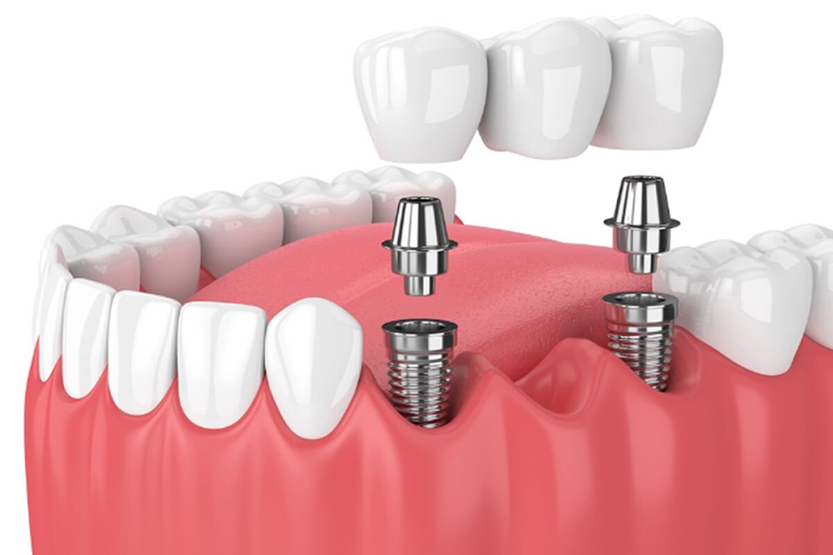 Dentisti a Reggio Emilia